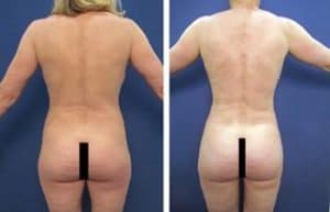 BBL with hd vaser liposuction procedure - back view