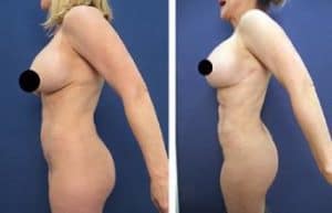 BBL with hd vaser liposuction procedure - left view