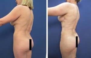 BBL with hd vaser liposuction procedure - back left view