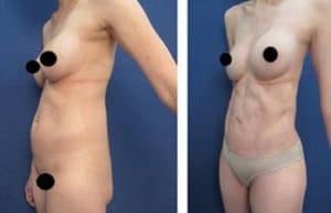 Abdominal etching with hd liposuction procedure – right oblique view