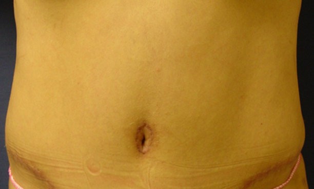 Tummy Tuck - Optimizing Belly Button Shape - Dr Laguna