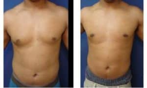 male breast surgery - front view