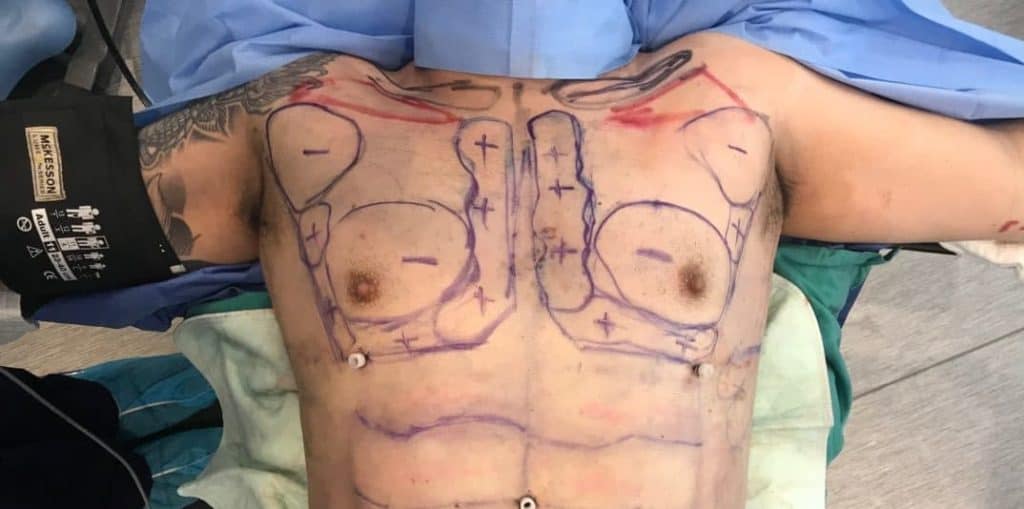 Male chest intra-operative markings