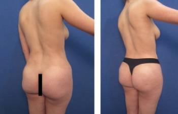 Procedimiento de grabado abdominal: vista posterior derecha