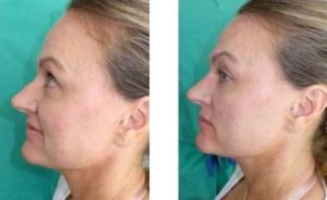 Facial fillers Before and After