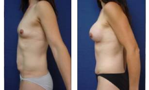 cirugía de abdominoplastia antes y después