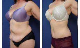 tummy tuck and liposuction surgery - left lateral view