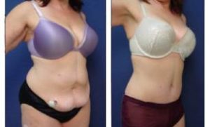 tummy tuck and liposuction surgery - right lateral view