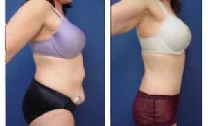 tummy tuck and liposuction surgery - right view