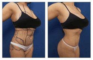 Liposuction