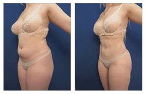 Liposuction