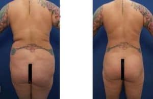 Hd liposuction before and after surgery result -back view