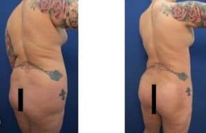 Hd liposuction before and after surgery result -back right view