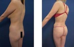 hd liposuction procedure - back left view