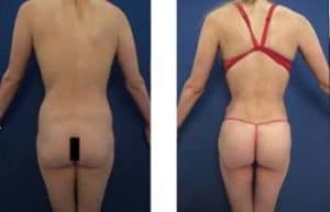 hd liposuction procedure - back view