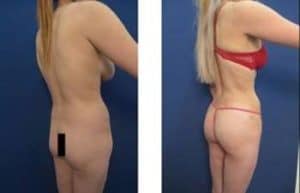 hd liposuction procedure - back left view