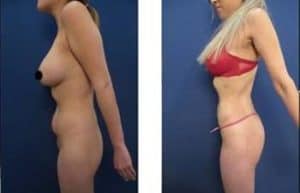 hd liposuction procedure - left view