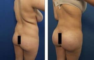 hd liposuction before and after procedure - back lateral view