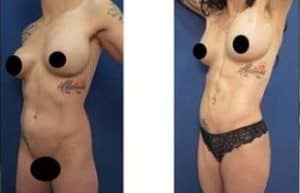 4D HD liposuction with chiseled abs - left lateral view