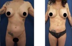 4D HD liposuction with chiseled abs - front view