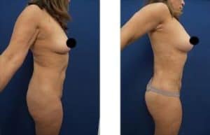 hd liposuction - right view