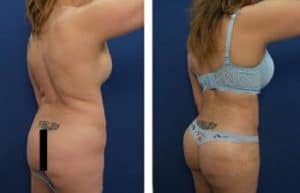 hd liposuction procedure – back right view