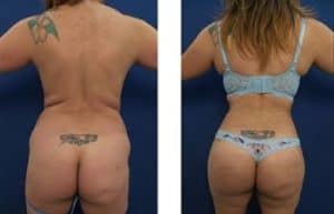 hd liposuction procedure – back view