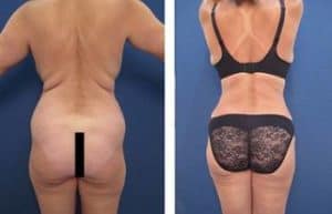 hd liposuction with BBL procedure - back view