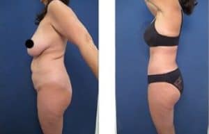 hd liposuction with BBL procedure - left view