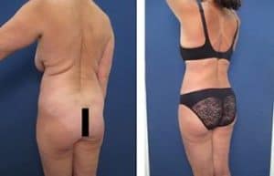 hd liposuction with BBL procedure - back left view