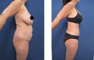 hd liposuction with BBL procedure - right view