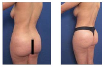 Procedimiento de grabado abdominal: vista posterior izquierda