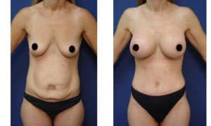 tummy tuck and breast procedure - front view