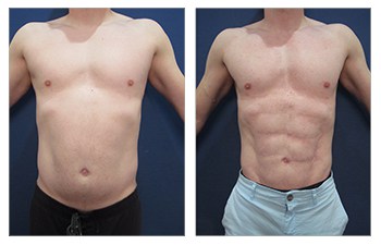 Abdominal etching and hd liposuction procedure – frontal view