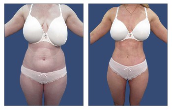 Abdominal etching procedure in female – front view