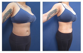 Abdominal etching procedure - right lateral view