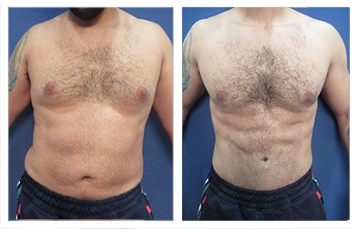 Abdominal etching and vaser liposuction procedure - frontal view