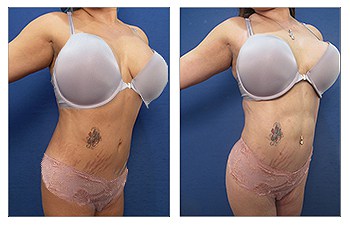 Abdominal etching and vaser lipo procedure – left oblique view