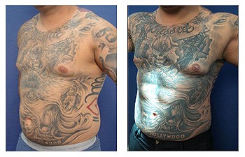 Abdominal etching and vaser liposuction procedure – right oblique view