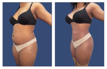 Abdominal etching procedure – left oblique view