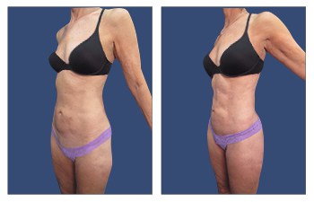 female abdominal etching procedure – left oblique view