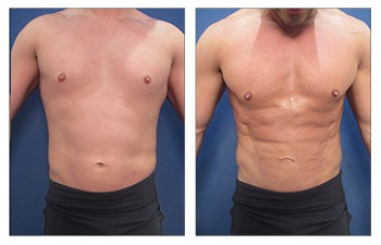 Male before and after abdominal etching procedure – frontal view