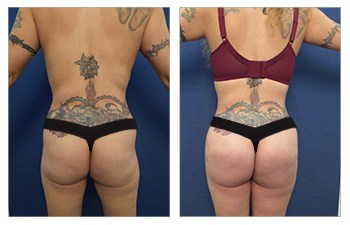 BBL before and after procedure - back view