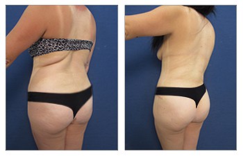 BBL before and after procedure - back view