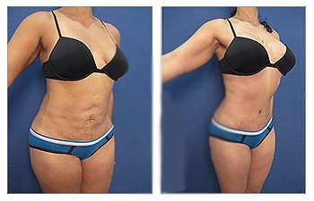 Lipo-Redo-8a